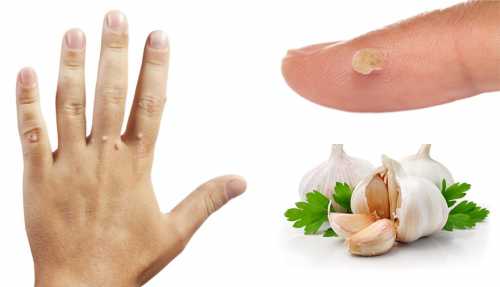 народные средства от папиллом в домашних условиях